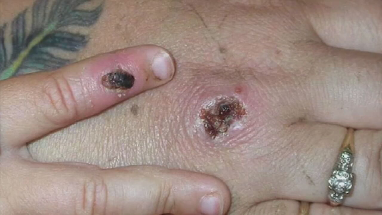 US Monkeypox cases double